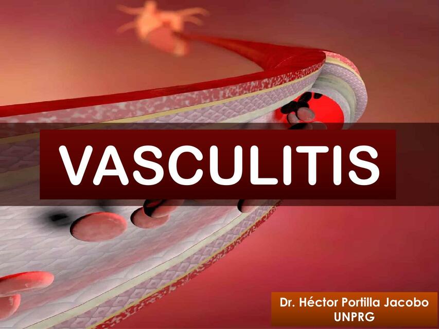 CLASE VASCULITIS