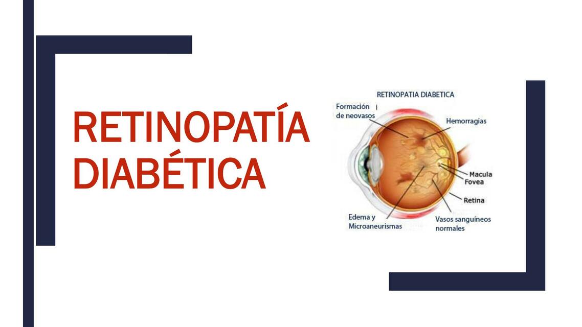 RETINOPATÍA DIABÉTICA