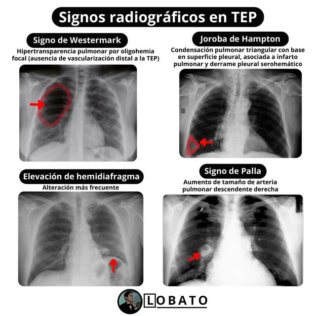 Signos radiográficos en Tromboembolia pulmonar 🩺