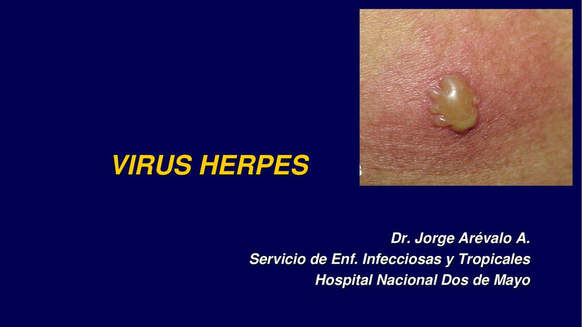 Virus Herpes Simple