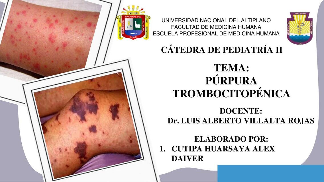 PURPURA TROMBOCITOPENICA