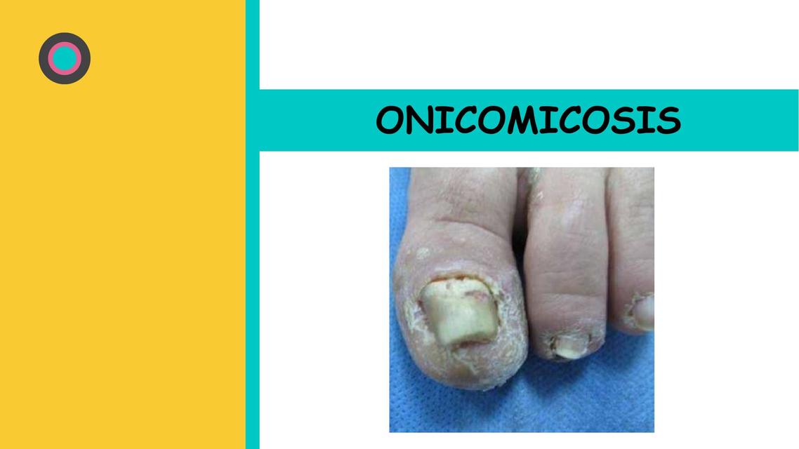 ONICOMICOSIS