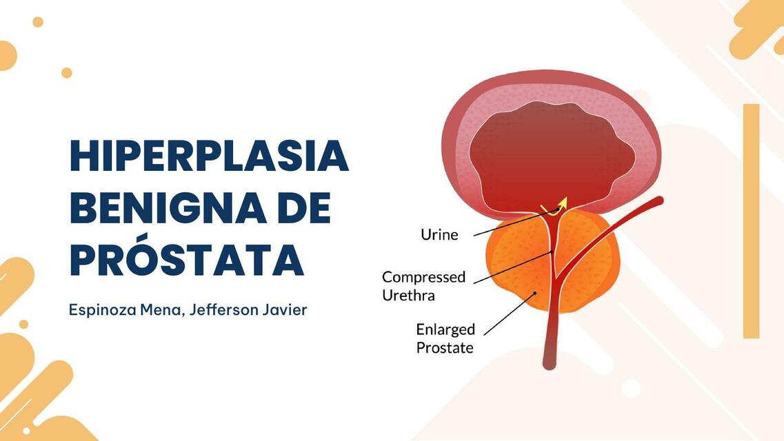 Hiperplasia Benigna de Próstata