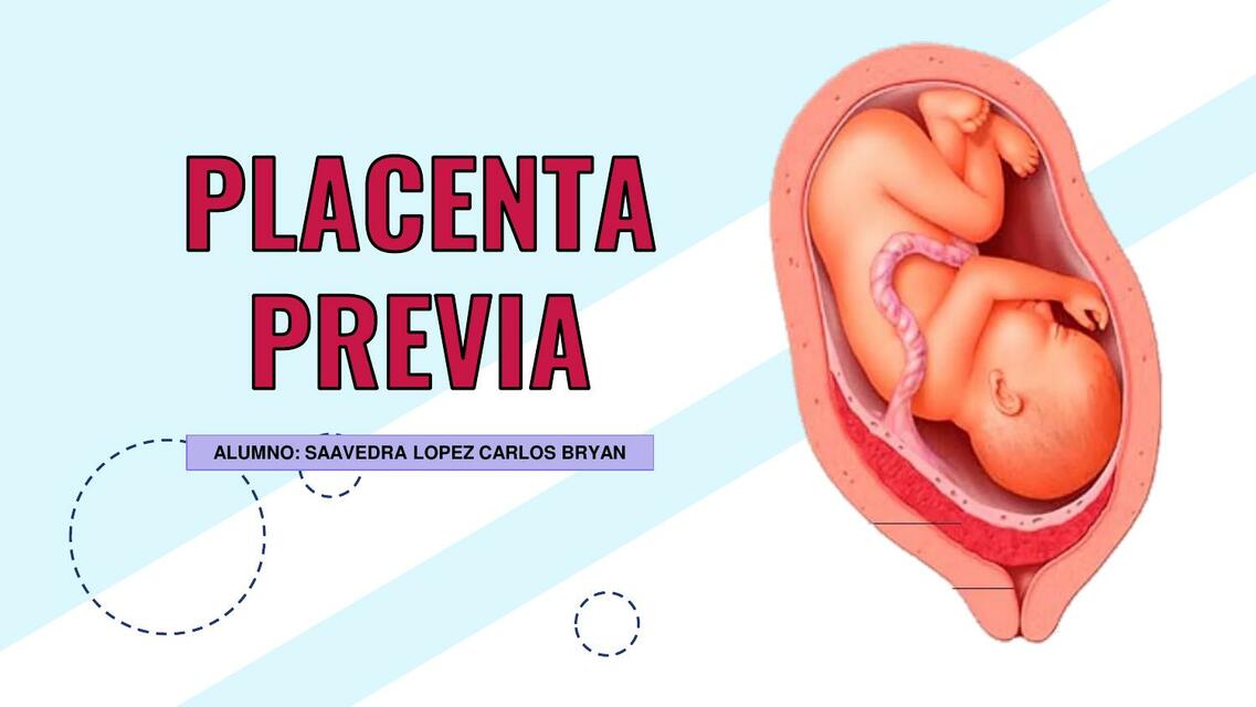 placenta previa