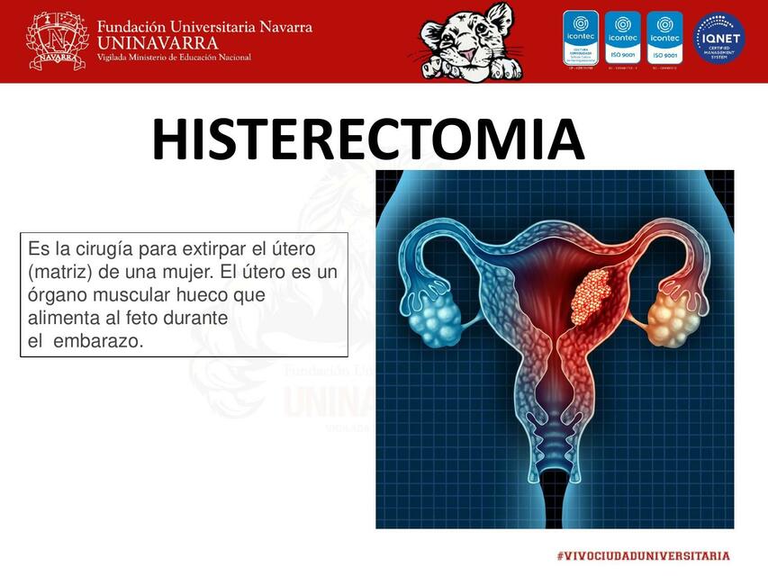 HISTERECTOMIA