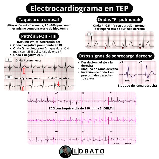 Patrón SI QIII TIII McGinn White 🩺| Electrocardiograma TEP