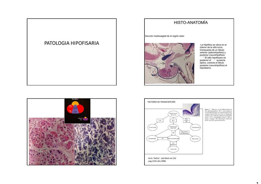 adenomas hipofisiarios 4 x página