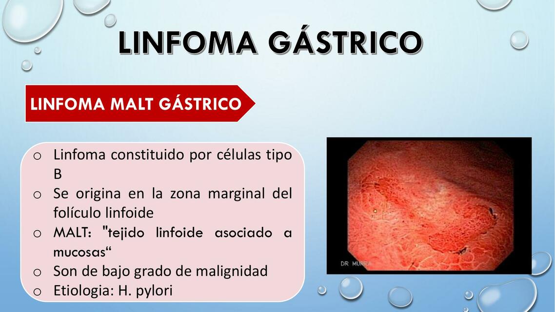 LINFOMA GASTRICO