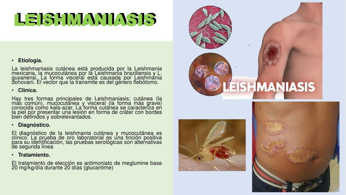 LEISHMANIASIS