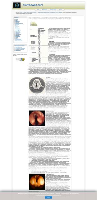 Distemia Laríngea