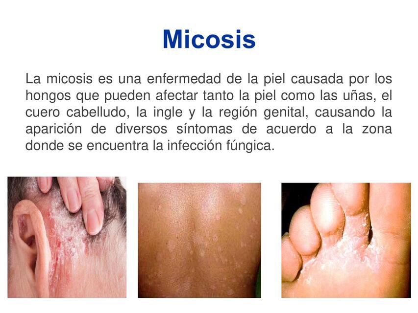 MICOSIS