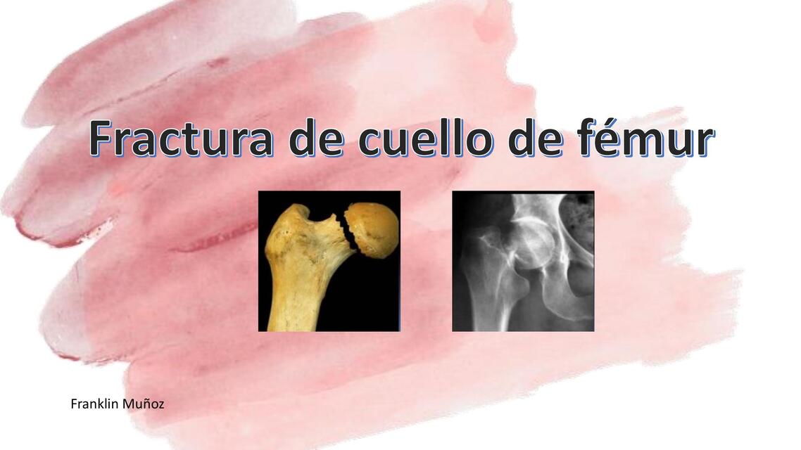 FRACTURA CUELLO DE FEMUR