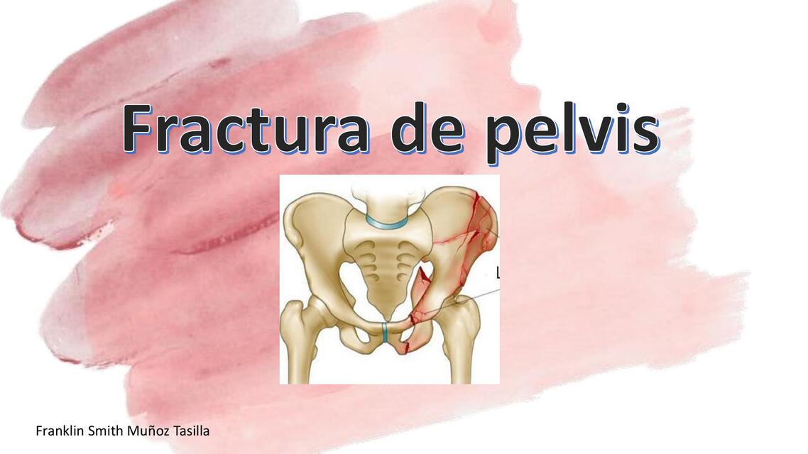 FRACTURA DE PELVIS