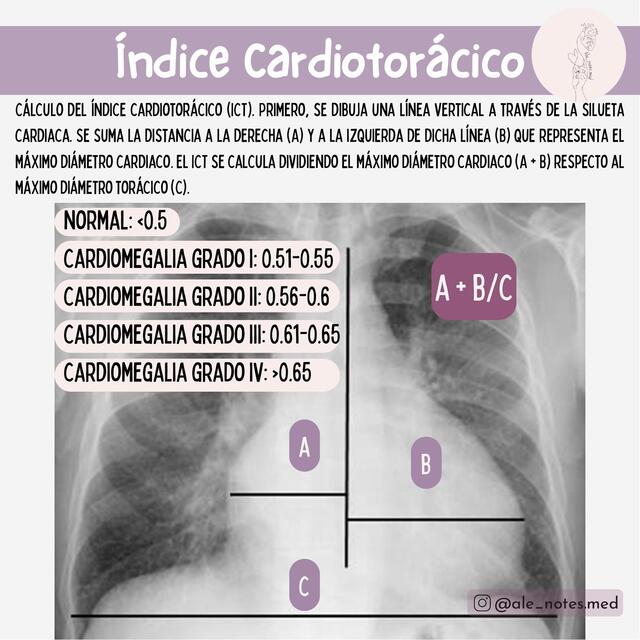 Índice Cardiotorácico