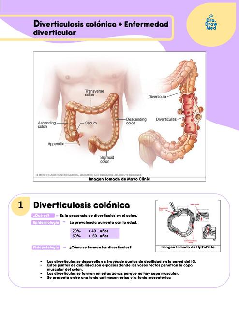 Enfermedades diverticulares