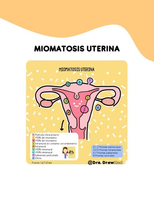 Miomatosis uterina