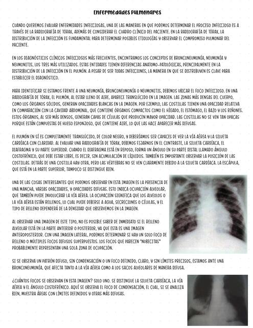 Infecciones Pulmonares