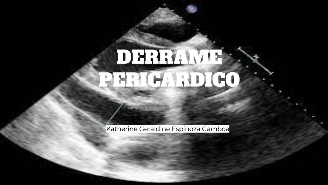 ECOGRAFIA DERRAME PERICARDICO