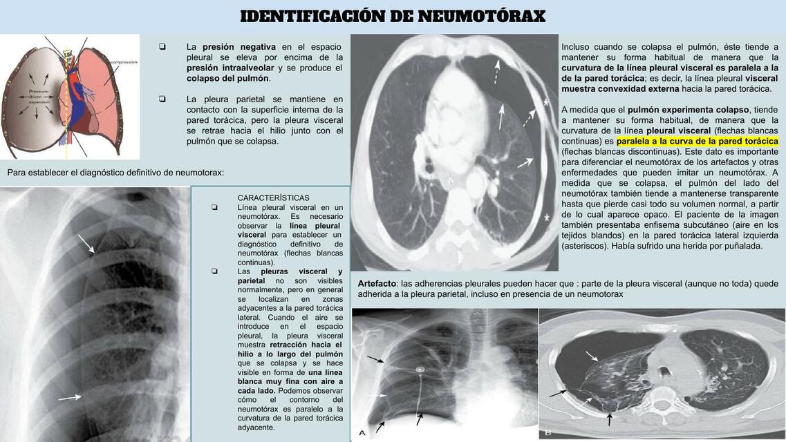 NEUMOTORAX - DERRAME PLEURAL