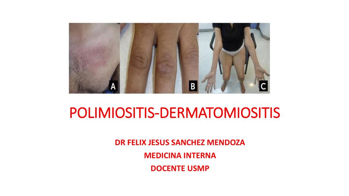 TEMA 9 Polimiositis dermatomiositis