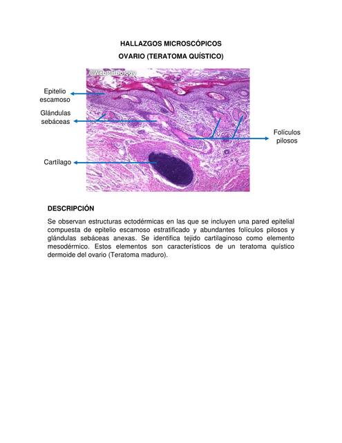 9 TERATOMA QUÍSTICO MICRO