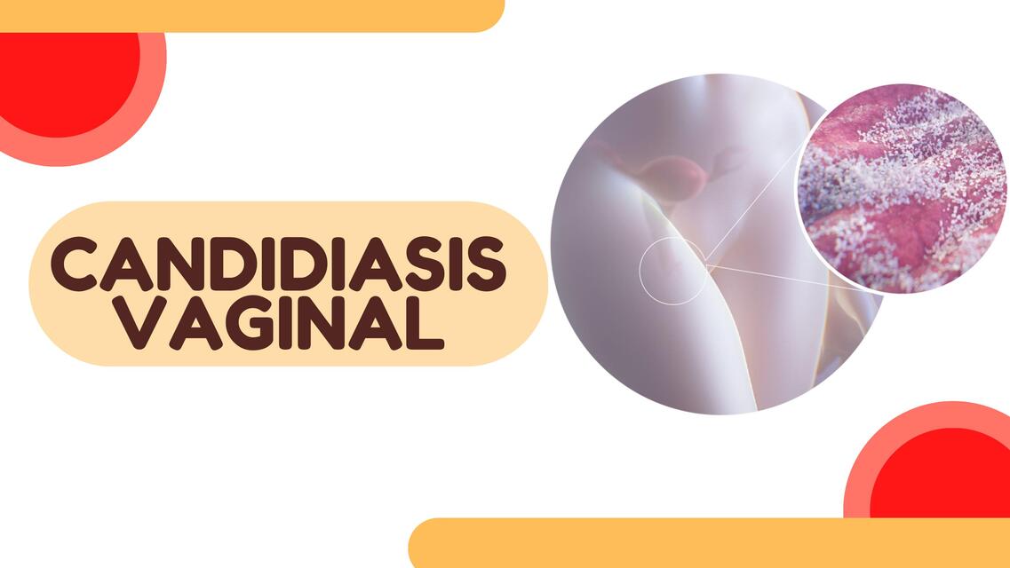 SX DE FLUJO VAGINAL: Candidiasis Vaginal