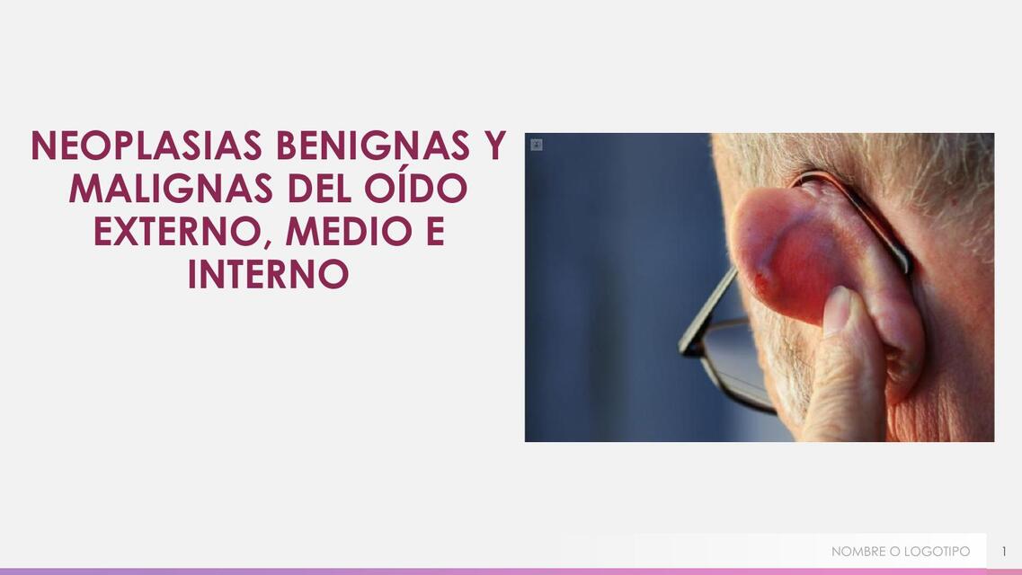 NEOPLASIAS BENIGNAS Y MALIGNAS DEL OÍDO EXTERNO ME