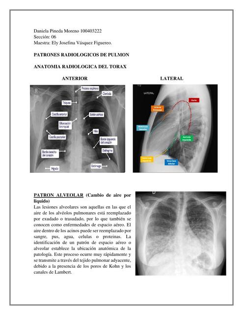 PATRONES RADIOLOGICOS DE PULMON Autoguardado