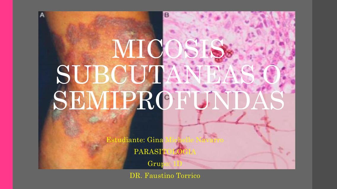 MICOSIS SUBCUTANEAS O SEMIPROFUNDAS