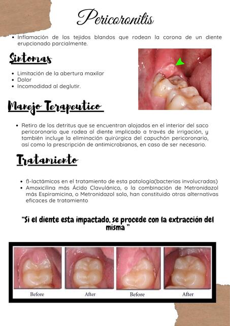 Pericoronitis