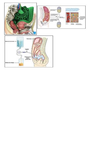 dialisis peritoneal