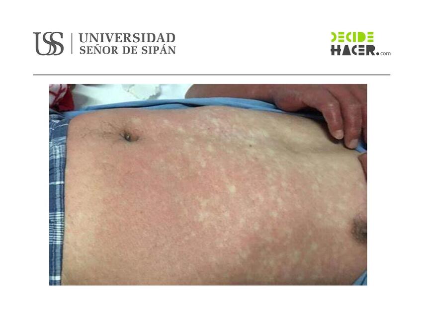 Clase 7 Exantema Febril Dr Benito Enshel Alex Udocz