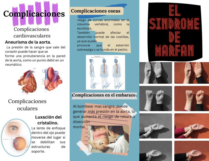 Sindrome de Marfan