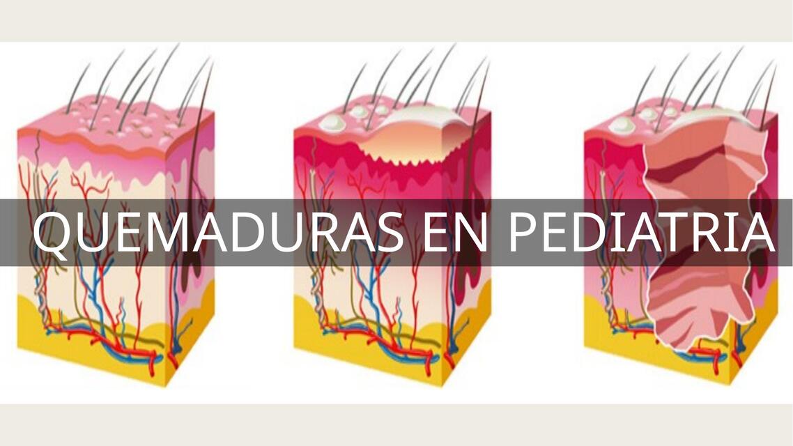 QUEMADURAS EN PEDIATRIA