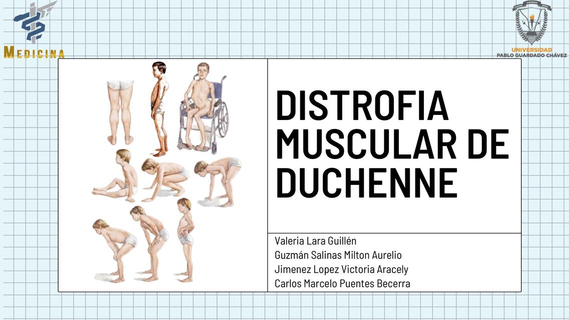 Distrofia Muscular de duchenne 1 | Carlos Puentes | uDocz