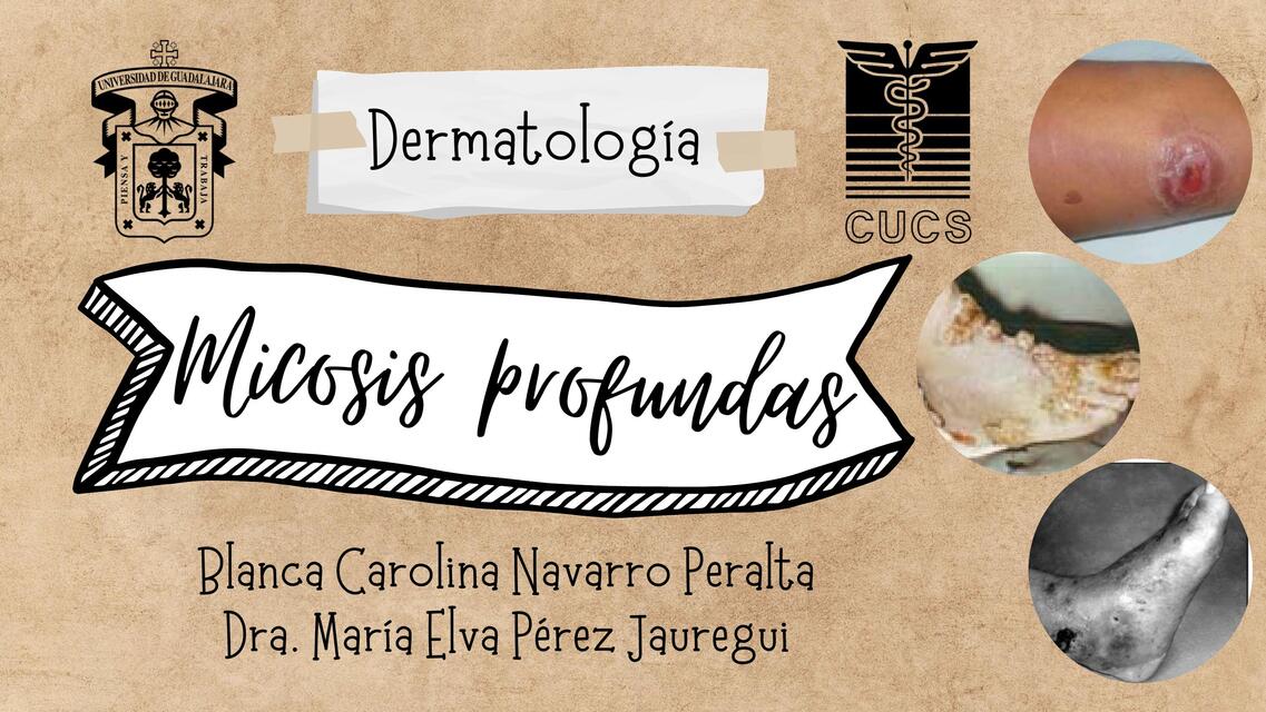 Micosis profundas Esporotricosis Cromomicosis Micetoma - Presentación