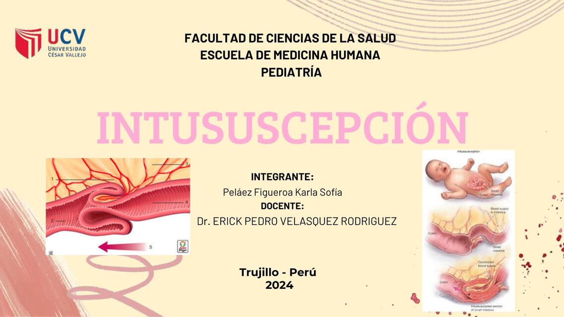 INTUSUSCEPCIONO FINAL