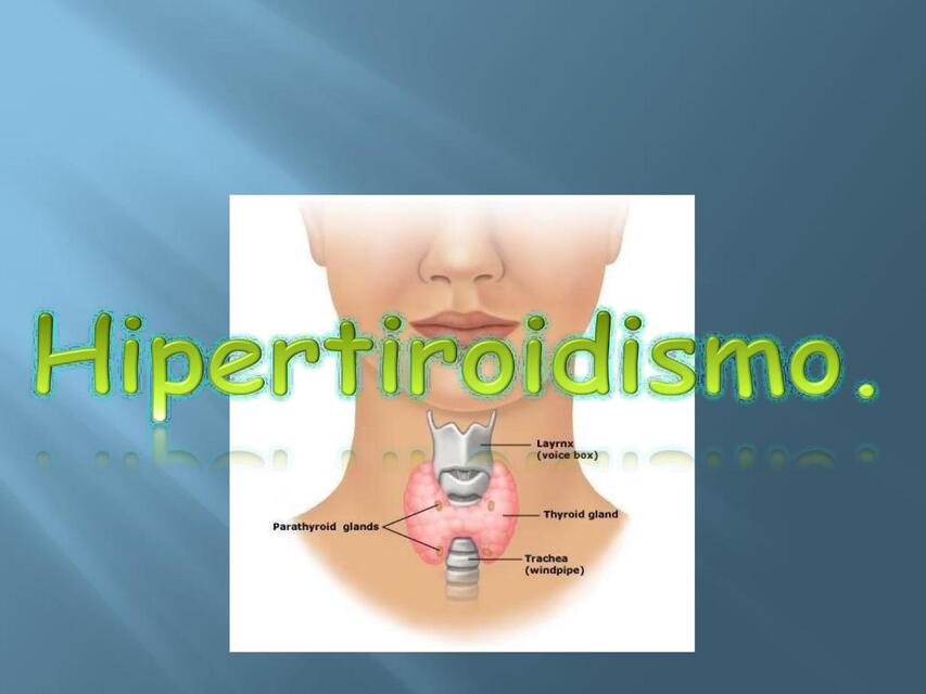 Hipertiroidismo