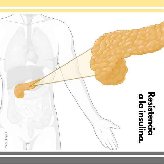 Resistencia a la insulina