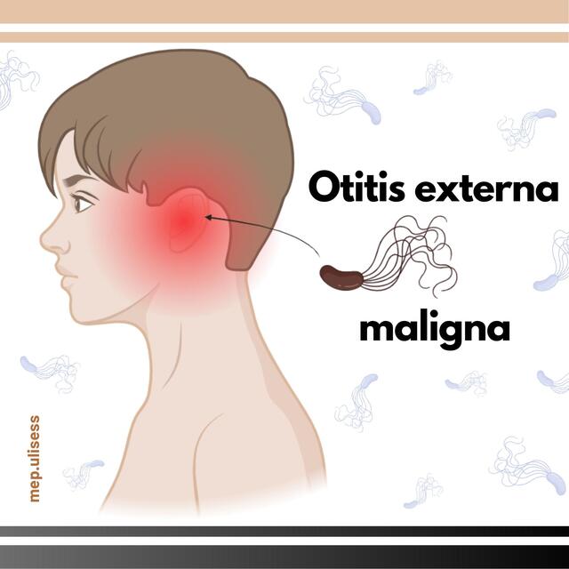 Otitis extrena maligna