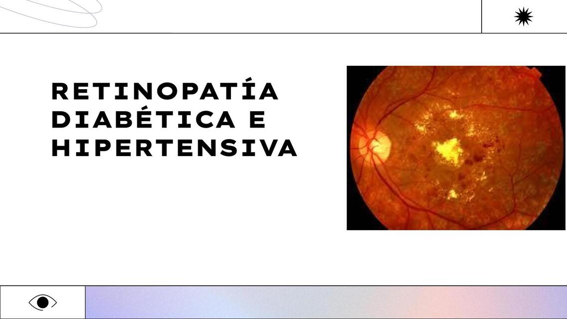 Retinopatía Diabética y Retinopatía hipertensiv