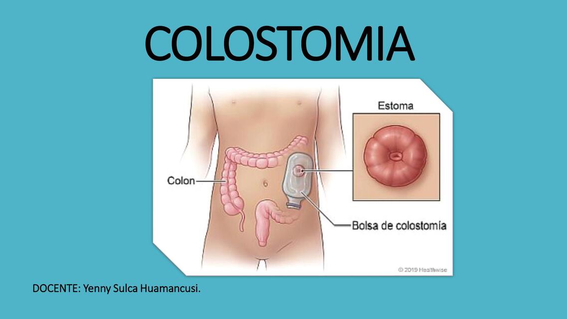 COLOSTOMIA