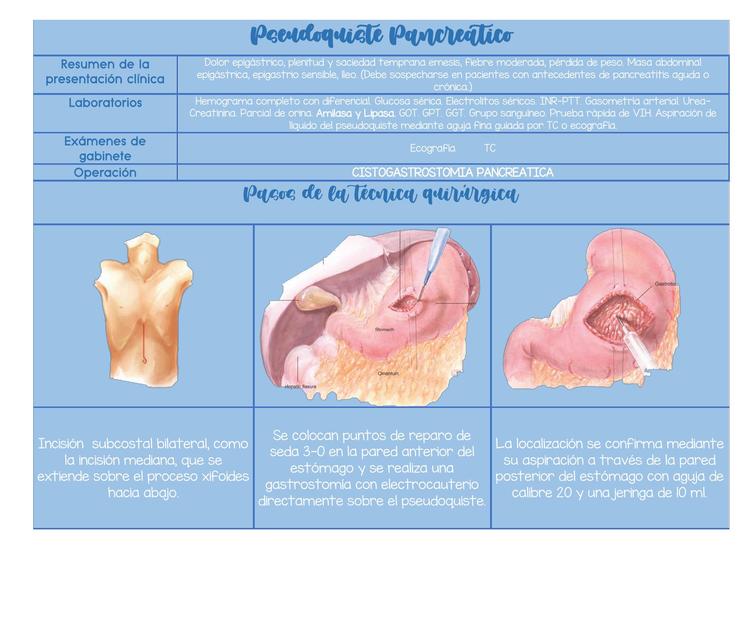 Pseudoquiste Pancreático