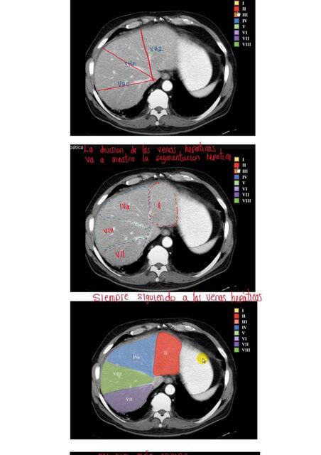 SEGMENTACIÓN HEPÁTICA 4