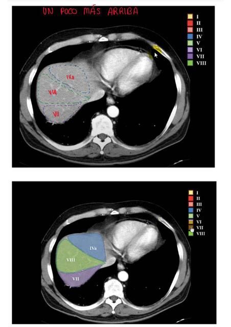 SEGMENTACIÓN HEPÁTICA 5