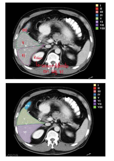 SEGMENTACIÓN HEPÁTICA 12