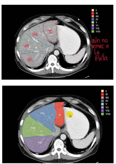 SEGMENTACIÓN HEPÁTICA 6