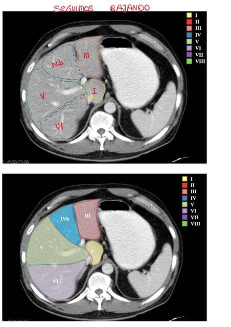 SEGMENTACIÓN HEPÁTICA 8