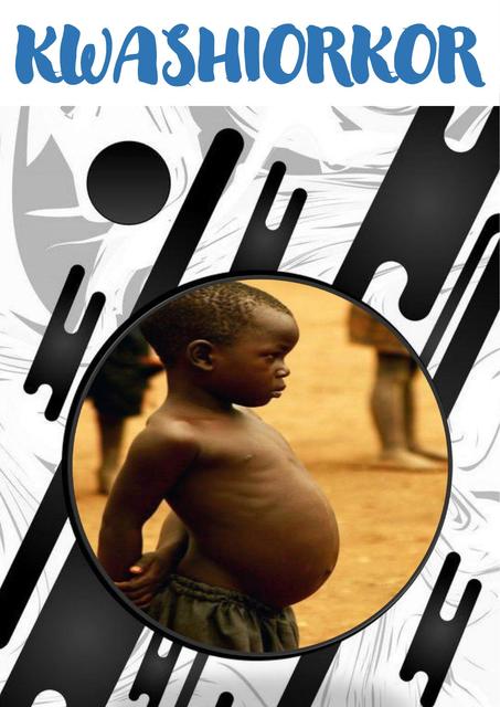 Kwashiorkor | Kwashiorkor | Desnutrición | uDocz