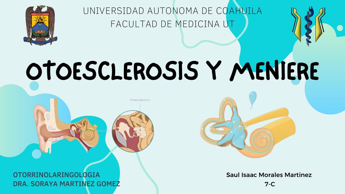 Otosclerosis | uDocz